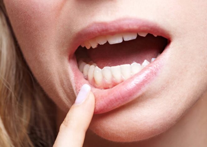 13 remedios naturais para aliviar as aftas mais depressa (e como usar)