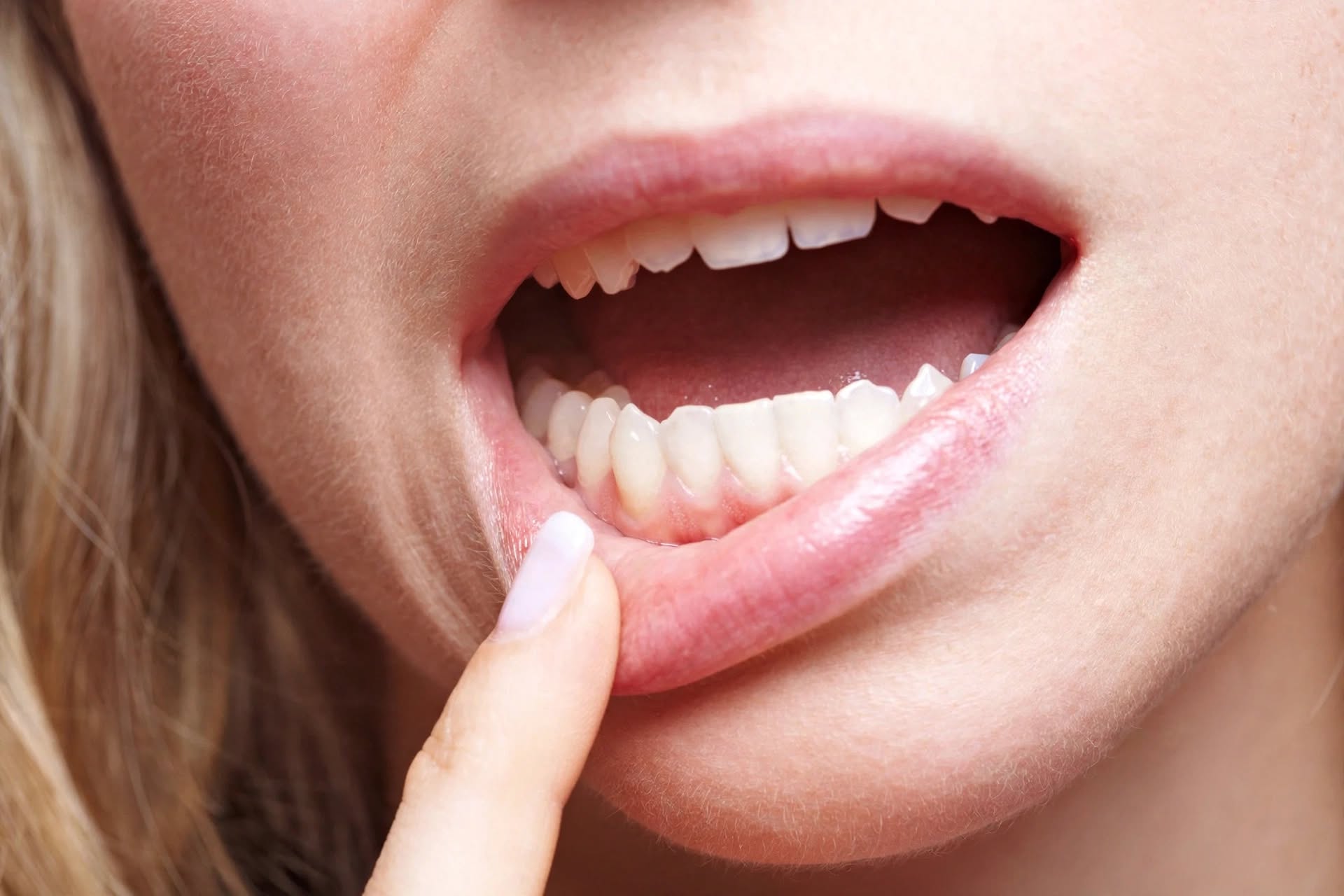 13 remedios naturais para aliviar as aftas mais depressa (e como usar)